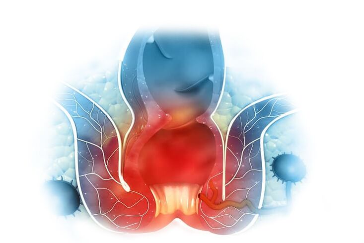 Effektiv Behandlung vun internen an externen Hämorrhoiden mat Proctonic Crème