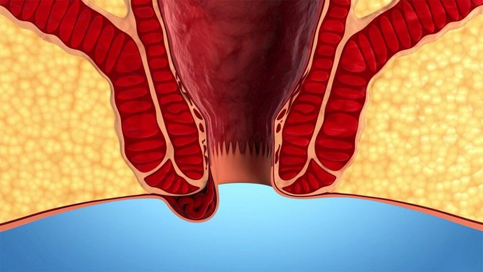 hemorrhoid Symptomer